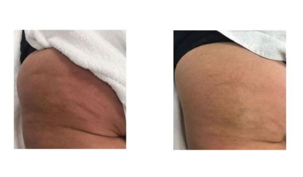 fessier femme avant après cellulite infrarouge