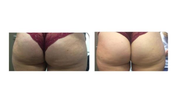 fessier femme avant après 5 séances infrarouge minceur