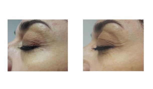 photo avant après contour des yeux infrarouge