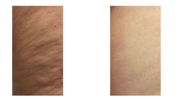 lissage peau cellulite avant après infrarouge diadermie